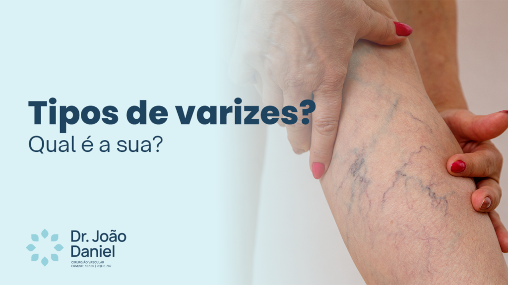 Tipos de varizes