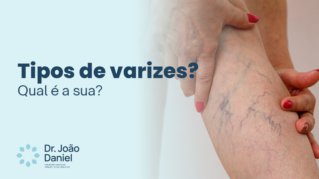 Tipos de varizes