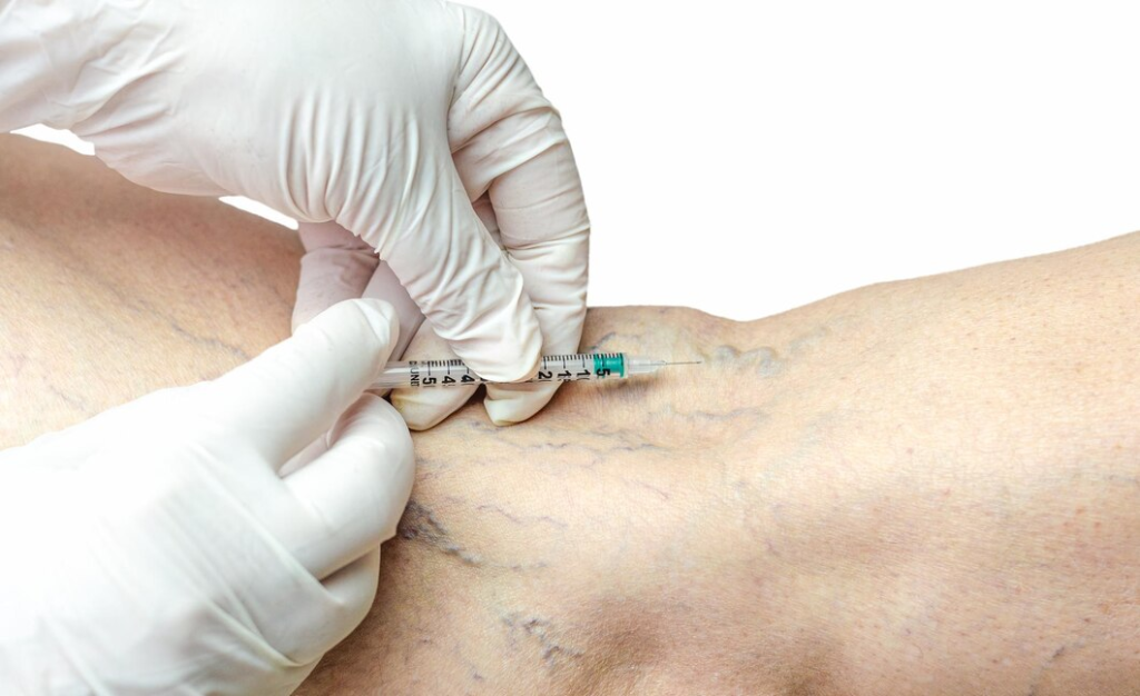 escleroterapia