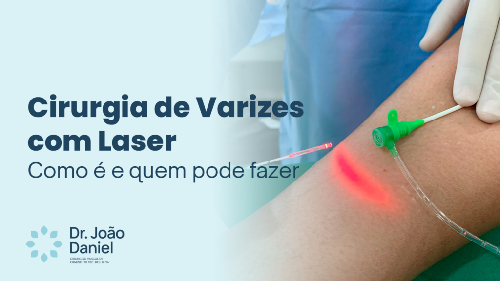 Cirurgia de Varizes com Laser - Como é e quem pode fazer