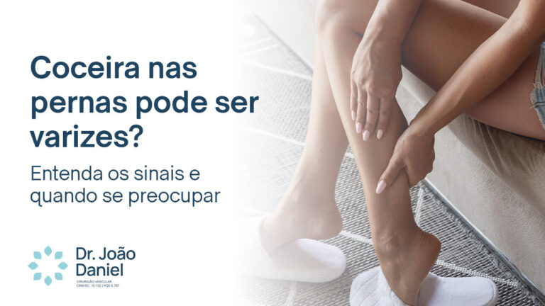 Coceira nas pernas pode ser varizes? Entenda os sinais e quando se preocupar